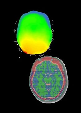 Elektromagnetische Simulation zur Bewertung der Sicherheit der Kombination von EEG und MRI