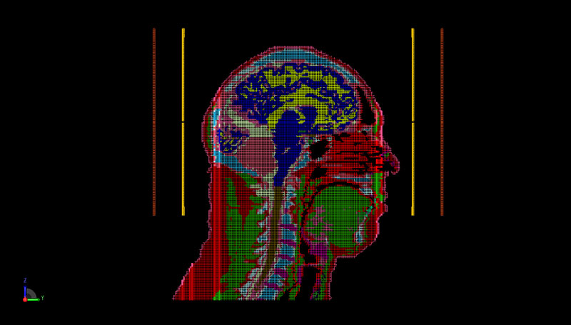 Abbildung 7: PrOGrid-Netzdarstellung der Sagittalebene des Kopfes und der Spulengeometrie.